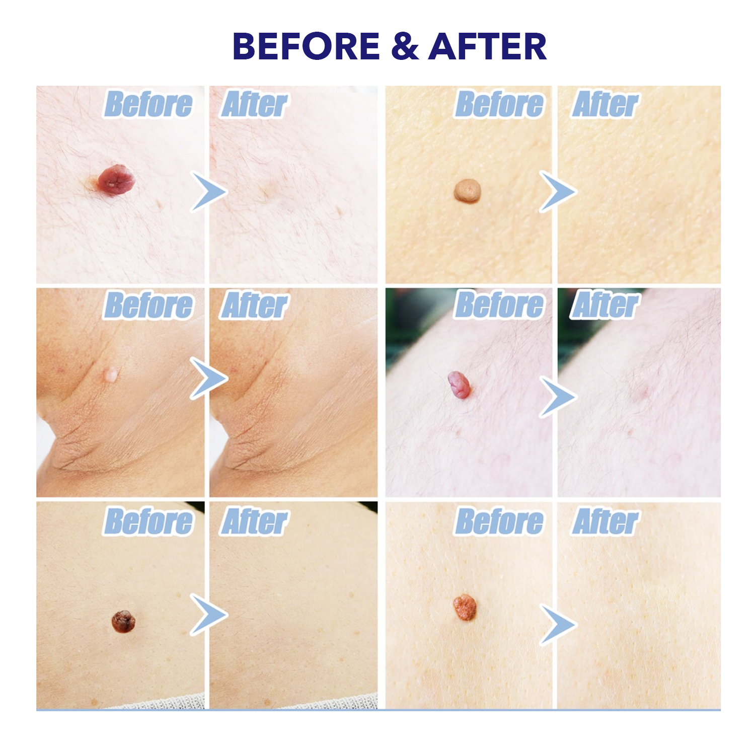 TagOff Skin Tag Removal Kit 2-IN-1 - Image 2
